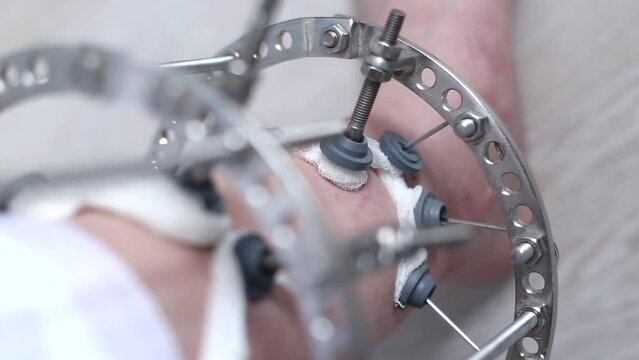 leg in Ilizarov's external fixator, Ilizarov's apparatus