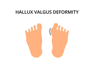 Foot with hallux valgus deformity. Bunion, problem, orthopedics. For topics like symptom, bone, podiatry
