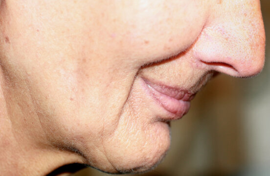 Flabbiness of the skin of the cheeks. Wrinkles on the face. Nasolabial wrinkles.