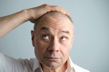 Obraz premium close-up old bald charismatic mature man showing his hair fall from head, patient with alopecia in hair growth clinic, topic of hair loss in men, selective focus. Anti-aging treatments for balding men