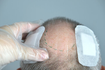 close-up trichologist treats patient, bald mature man with alopecia in hair growth clinic,...