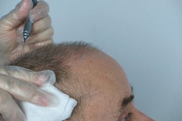 close-up trichologist treats patient, bald mature man with alopecia in hair growth clinic,...