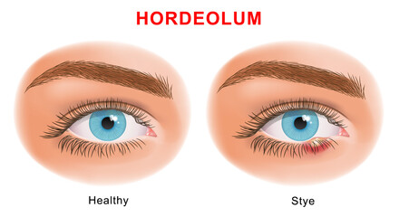 Eye Stye (Sty) problem before and after treatment. external hordeolum of lower eyelid. stye vector illustration.