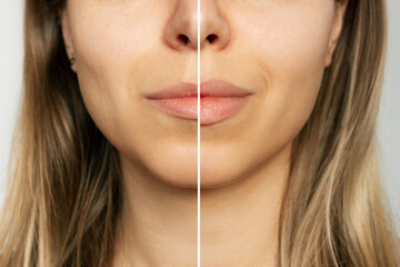 Cropped shot of young blonde woman's face with lips before and after lip enhancement on a gray background. Injection of filler in lips. Lip augmentation - obrazy, fototapety, plakaty