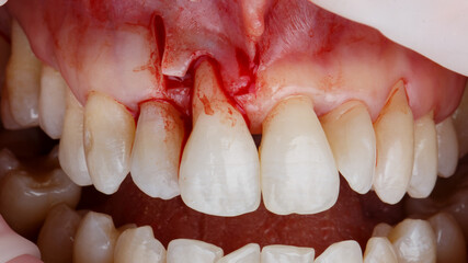 Called root of the central before adding the flap of soft tissues and the restoration of the volume...