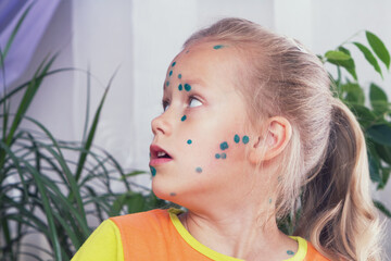 Portrait of a child girl suffering from chicken pox.