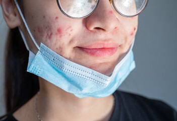 Close up of young Asian woman open her mask and showing acne problem occur on her skin caused of...