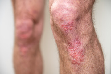Acute psoriasis on elbows is an autoimmune incurable dermatological skin disease. Large red, inflamed, flaky rash on the knees. Joints affected by psoriatic arthritis