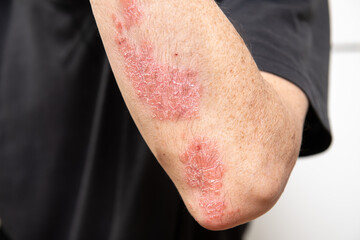 Acute psoriasis on elbows, knee is an autoimmune incurable dermatological skin disease. Large red,...