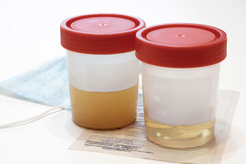 Urine jars on a white background, good and bad urinalysis. Disposable container for taking...