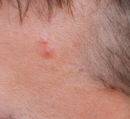 Fototapeta premium Pimples on the forehead of man. Acne on the forehead