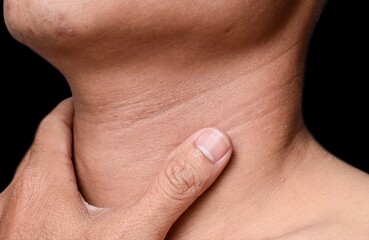 Aging skin folds or skin creases or wrinkles at neck of Asian old man. Concept of sore throat,...