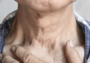 Aging skin folds or skin creases or wrinkles at neck of Asian old man. Concept of sore throat.