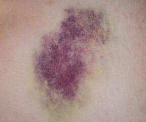 Fototapeta premium A large bruise on a person body