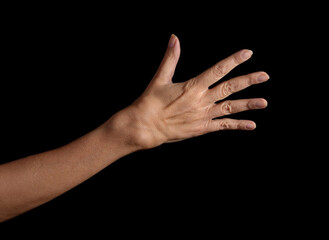 Female wrist with Rheumatoid Arthritis