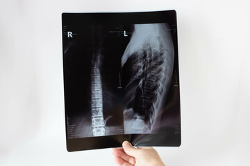 Medical X-ray of the teenager's back.The concept of medical healthcare