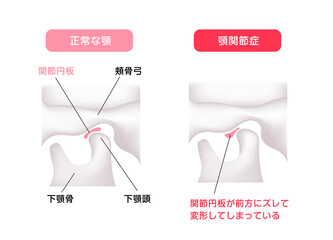 正常な顎（あご）と顎関節症の顎 / 間接円板の違い ベクターイラスト
