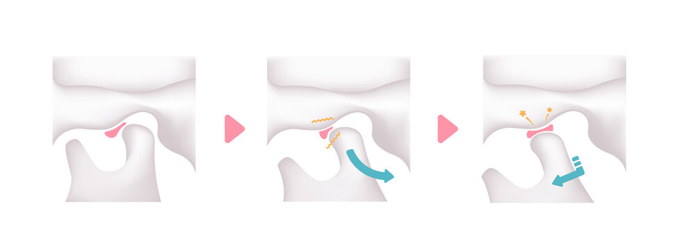 Illustration of the cause of temporomandibular disorders (TMD)