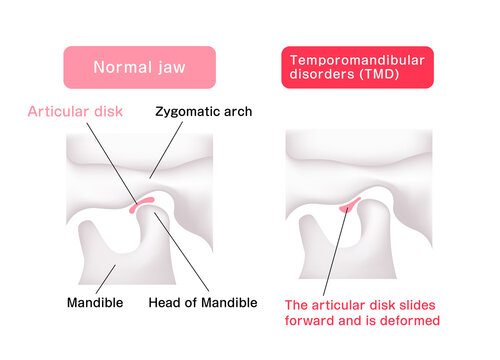 Illustration comparing the shapes of the articular disk ( normal jaw and Temporomandibular disorders )