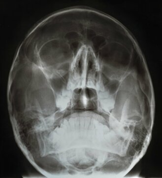 X-ray of the skull for examination by a doctor. Traumatic brain injuries. The concept of medicine and science.