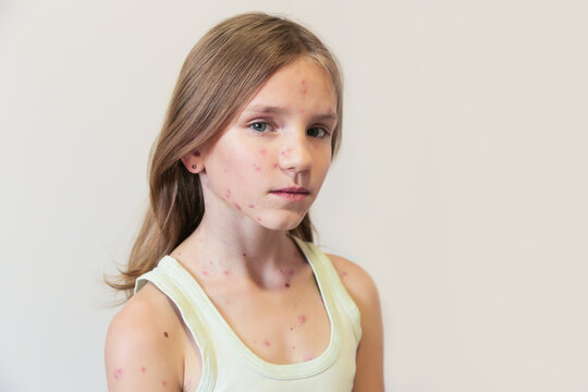 Cute little girl with chickenpox at home. Varicella zoster virus.
