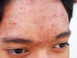 Closeup teenage Asian boy with acne problem on face.