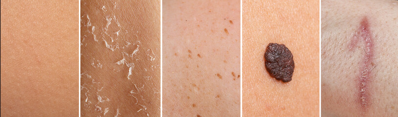 Composition with normal, dry, blemished and scarred skin and skin with a mole