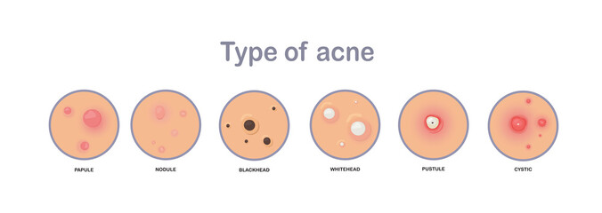 Acne concept. type of acne.papule,nodule,blackhead'whitehead,pustule,cystic.flat vector illustration.