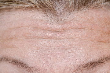 Woman face wrinkle on forehead before rejuvination procedures, injections, treatment, surgery