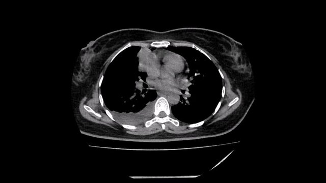 lung ca and effusion 