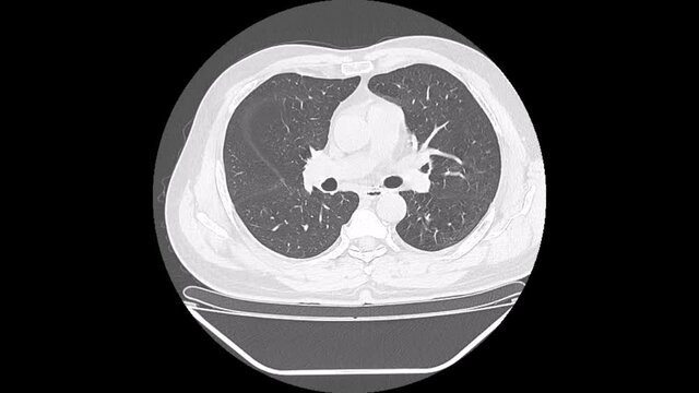 right lung  carcinoma, lung window, axial view, chest ct scan
