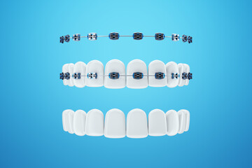 White teeth with metal braces on a blue background. Dental braces, orthodontic treatment, dentistry, teeth whitening, protection, oral care, hygiene, healthcare. 3D illustration, 3D render. - obrazy, fototapety, plakaty