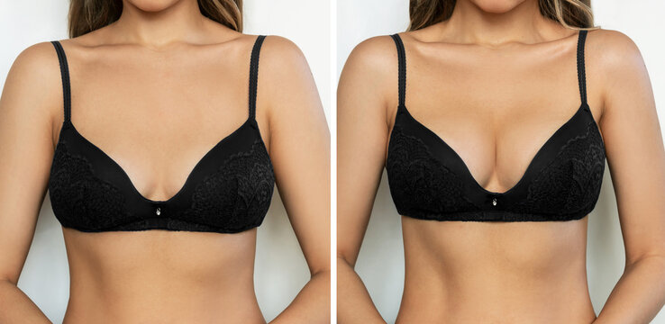 Cropped shot of young tanned woman in bra before and after breast augmentation with silicone implants. The result of a breast lift. Breast size correction on white background. Plastic surgery concept