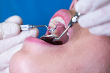 Dentist checking a patient's mouth