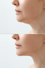 A close portrait of an aged woman before and after facial rejuvenation procedure. Correction of the...