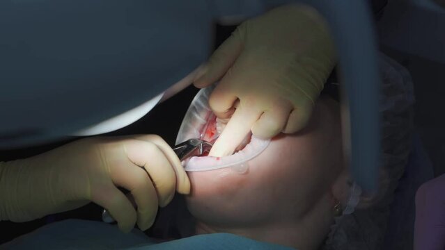 real. dentist pulls out a sick wisdom tooth. 