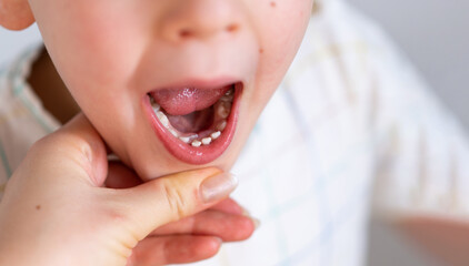 Children shark teeth, first tooth that appears in childhood behind baby teeth. Toothache. Process of removing a baby tooth. Emotions of a child