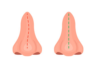 Curve and correct nose, correction nasal curvature, surgery rhinoplasty. Nose before and after treatment. Vector illustration - obrazy, fototapety, plakaty