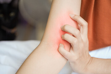 Woman scratching her arm because of itchy arm.
