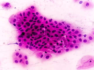 Pap's smear pap stain Microscopic 100x Zoom show High-grade squamous intraepithelial lesion is a...
