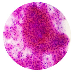 Pap's smear pap stain Microscopic 40x Zoom show High-grade squamous intraepithelial lesion is a...