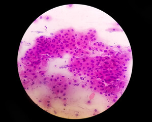 Pap's smear pap stain Microscopic 40x Zoom show High-grade squamous intraepithelial lesion is a pre-cancerous, sexually transmitted disease