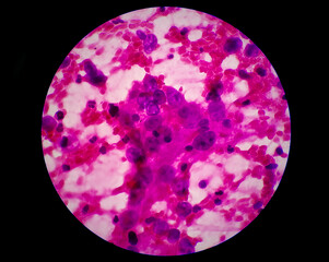 Photomicrograph of Metastatic adenocarcinoma of lung. Pleural fluid FNAC, 40X