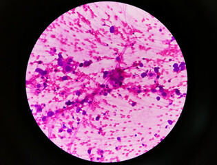 Photomicrograph of Metastatic adenocarcinoma of lung. Pleural fluid FNAC, 40X