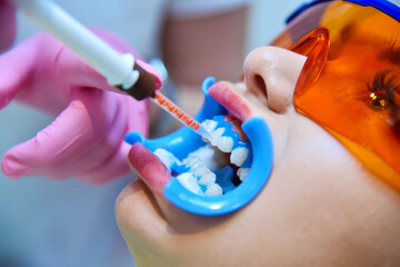 Dentist applies gel to teeth before bleaching teeth