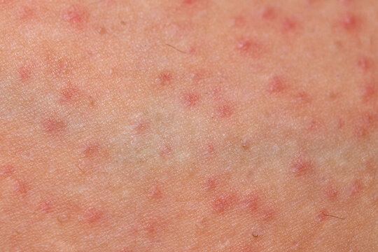 Folliculitis on female skin