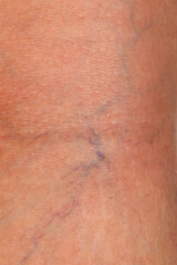 Fototapeta premium Varicose veins on female leg