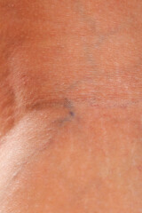 Fototapeta premium Varicose veins on female leg