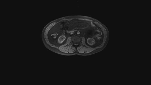 Voluminous CT scan of the abdomen. Computed tomography of the gastrointestinal tract, liver and kidneys