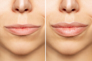 Two shots of young woman's lips before and after lip enhancement. Injection of filler in lips. Lip...